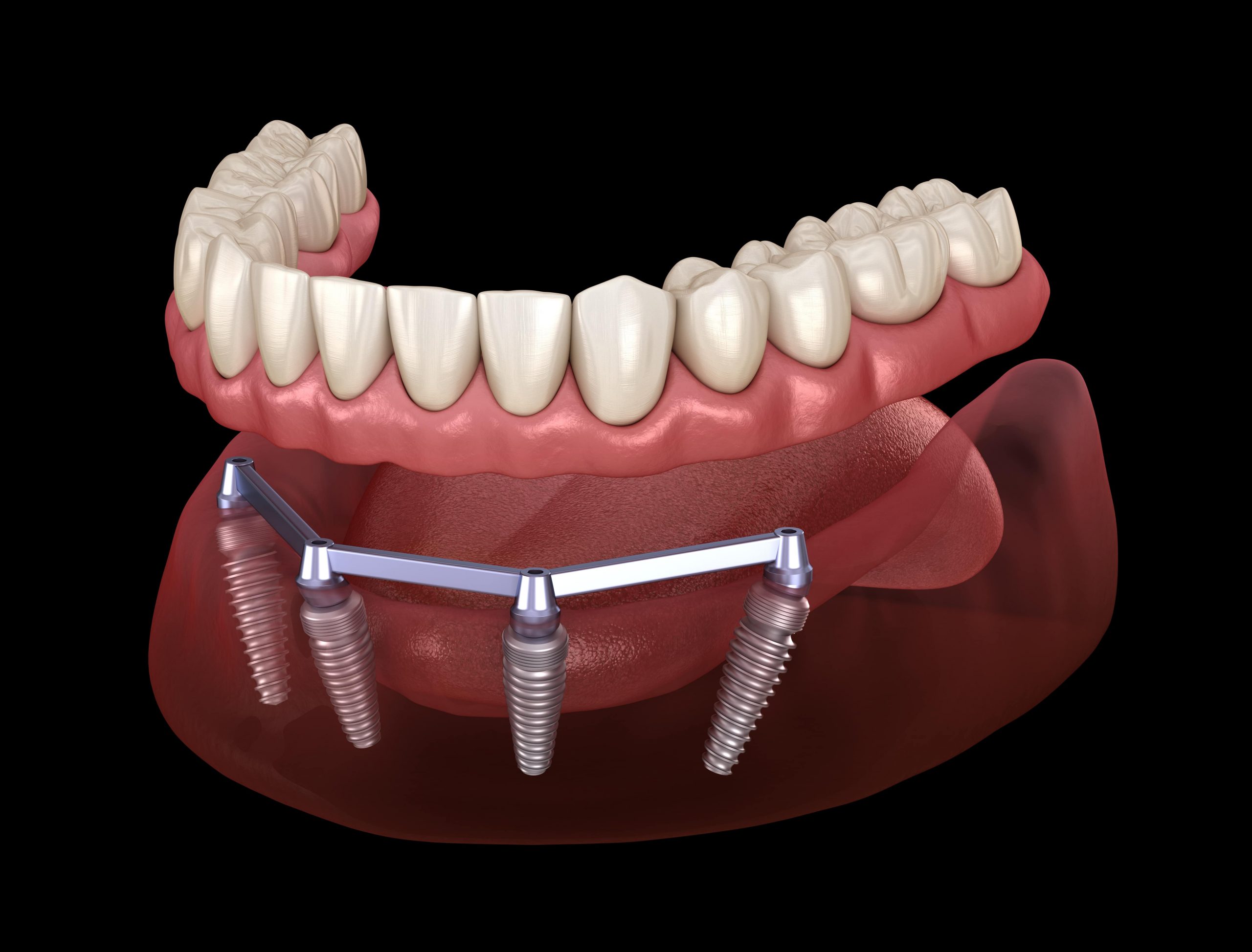 Crafting Resilient Smiles: The Role of Dental Implants in Stress Adaptation