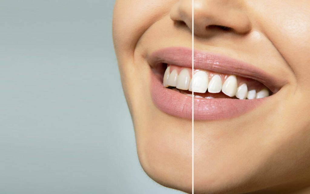 The Journey of Veneers: Enhancing Functionality and Beauty