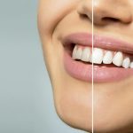 The Journey of Veneers: Enhancing Functionality and Beauty