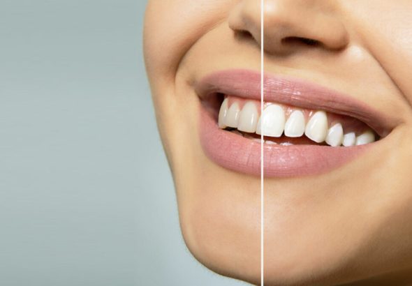 The Journey of Veneers: Enhancing Functionality and Beauty