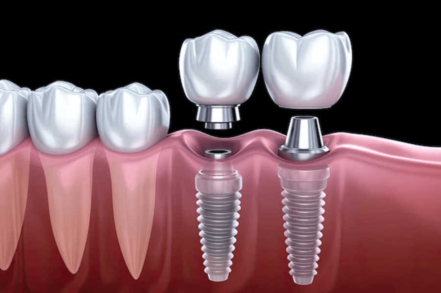 Journey to a Seamless Smile: The Biocompatibility of Dental Implants